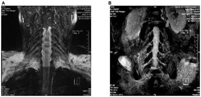 Case report: Anti-CNTN1 antibody-associated nodopathies disease with asymmetric onset